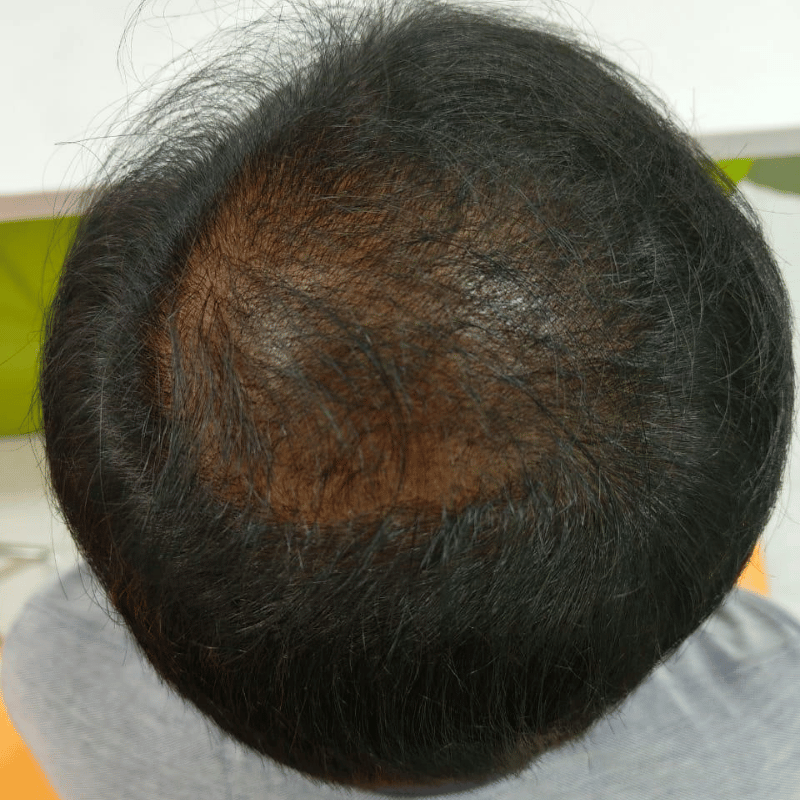 Hair Loss After