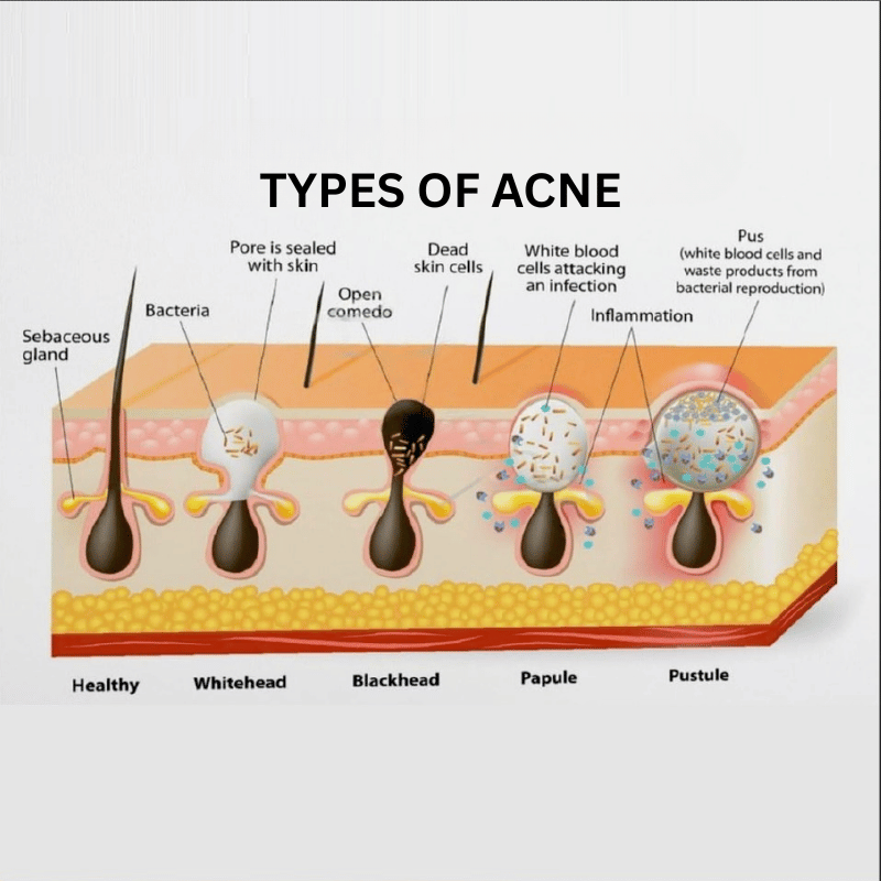 Types of Acne Pimples